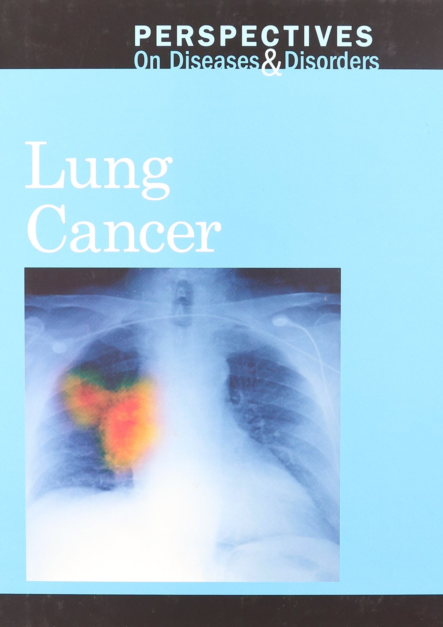 Lung Cancer (Perspectives on Diseases and Disorders)