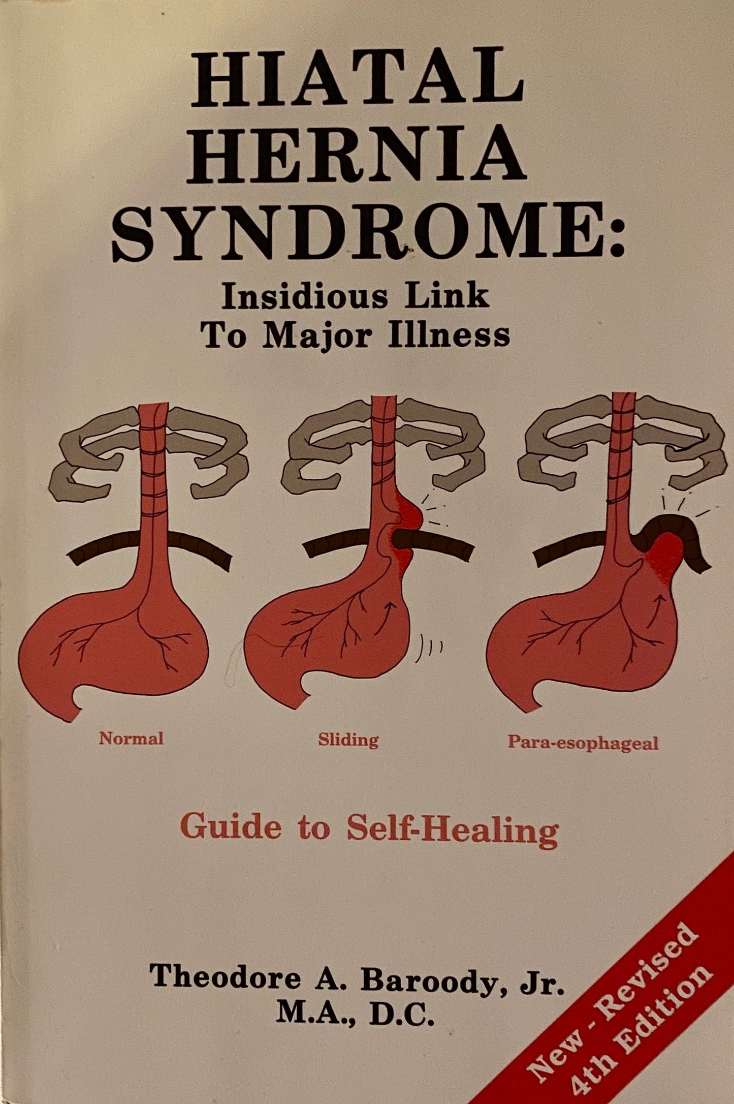Hiatal Hernia Syndrome: Insidious Link to Major Illness Guide to Healing - 6142