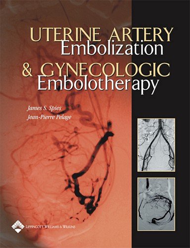 Uterine Artery Embolization And Gynecologic Embolotherapy