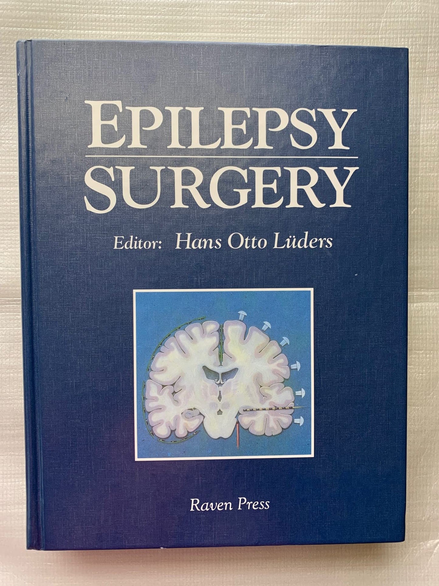Epilepsy Surgery
