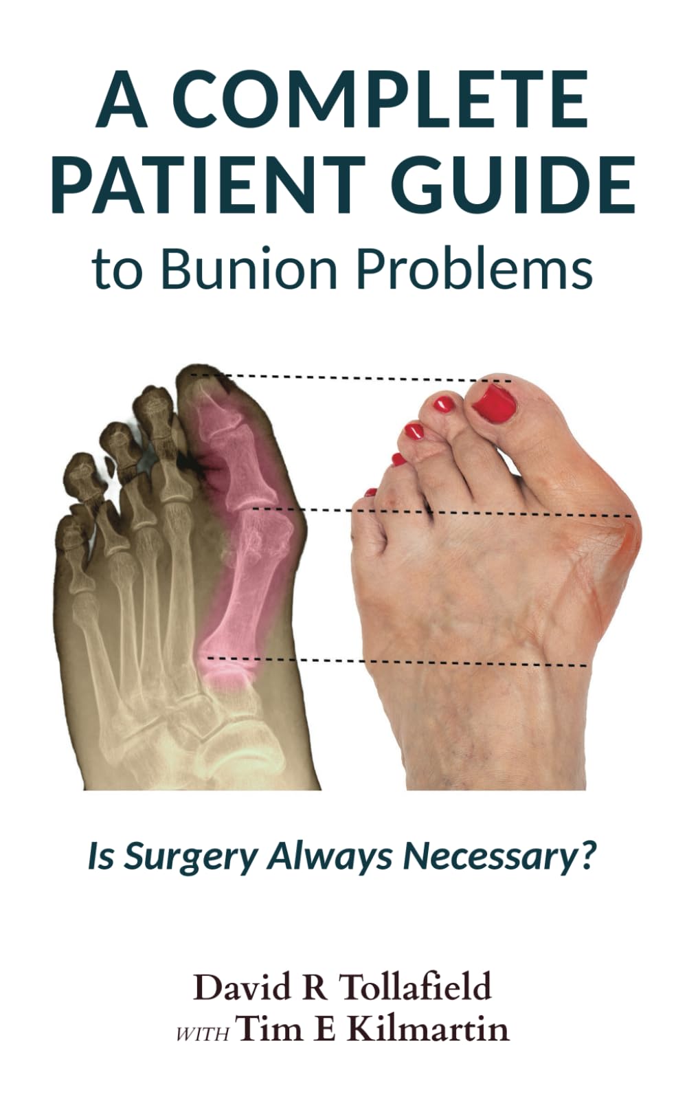 A Complete Patient Guide to Bunion Problems: Is Surgery Always Necessary? (Health Guide Books) - 9063